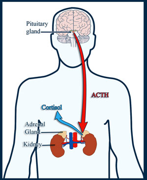 Cushing's disease